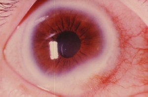 Дистрофия роговицы глаза