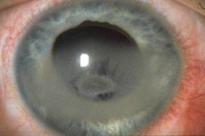 Дистрофия роговицы глаза