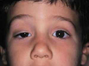 Синдром верхней глазничной щели