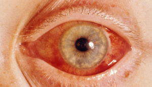 лечится первичная глаукома