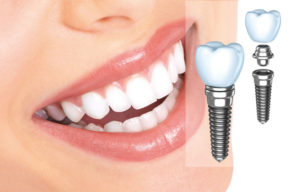 Что такое зубные импланты и в чем преимущества системы Nobel Biocare