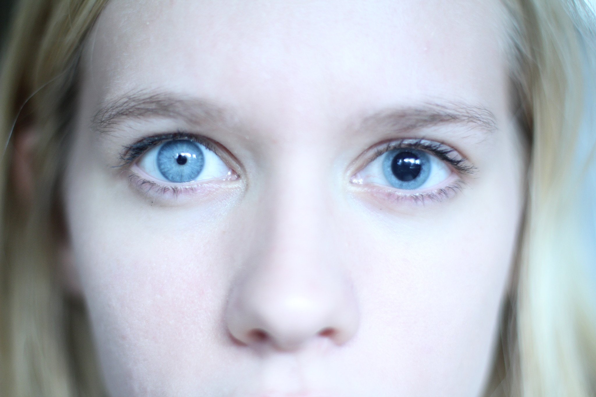 Почему глаза стали голубые. Миоз мидриаз анизокория. Гетерохромия и анизокория. Гетерохромия радужной оболочки.