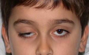 Синдром верхней глазничной щели