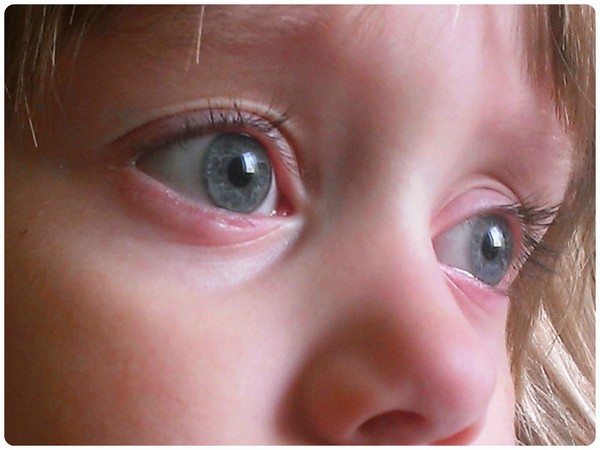 Конъюнктивит ребенка 6 лет. Воспаленный глаз у ребенка.