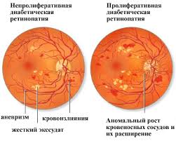 гипертоническая ретинопатия