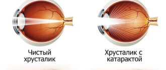 Что хуже катаракта или глаукома?