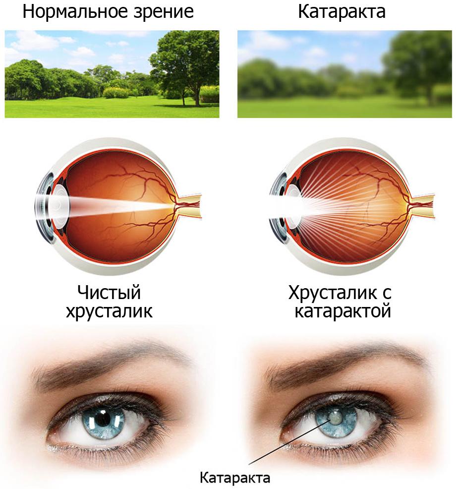 Что хуже катаракта или глаукома?