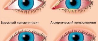 Что такое Эписклерит глаз?