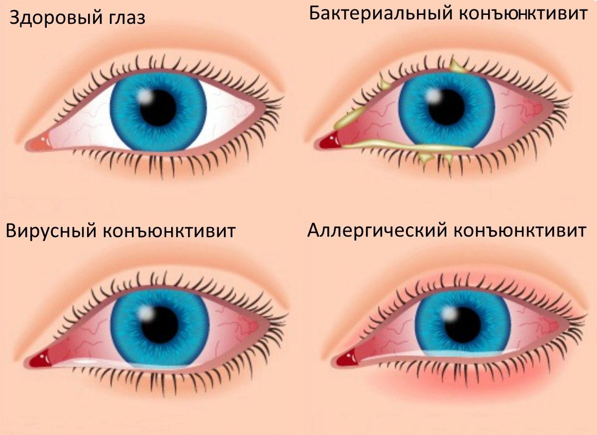 Что такое Эписклерит глаз?