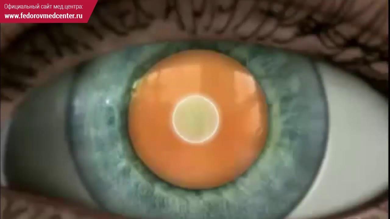 Что такое начальная стадия катаракты?