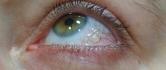 Что за нарост на белке глаза?