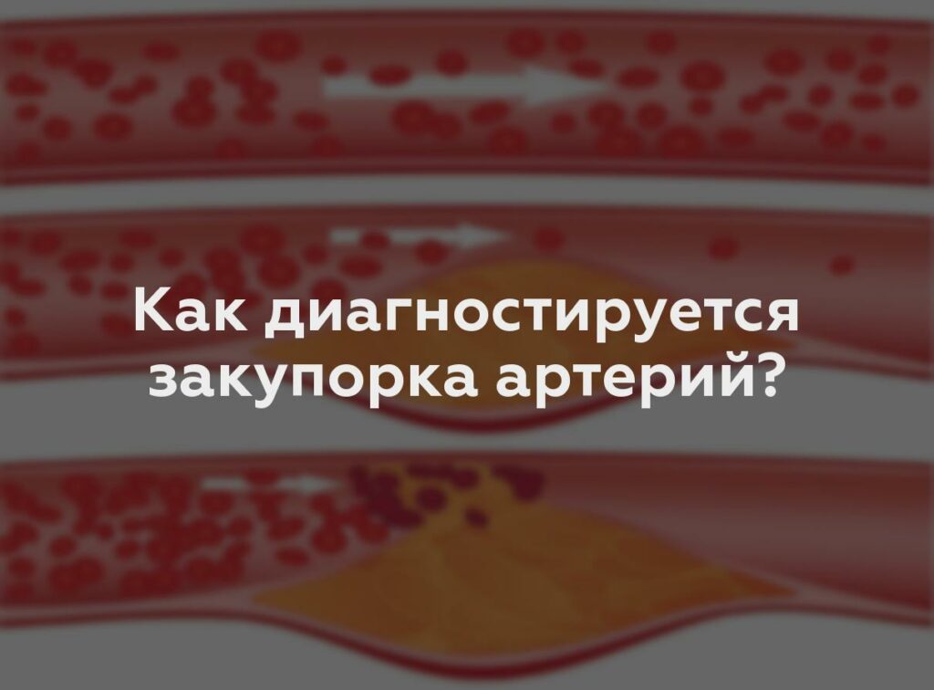 Как диагностируется закупорка артерий?