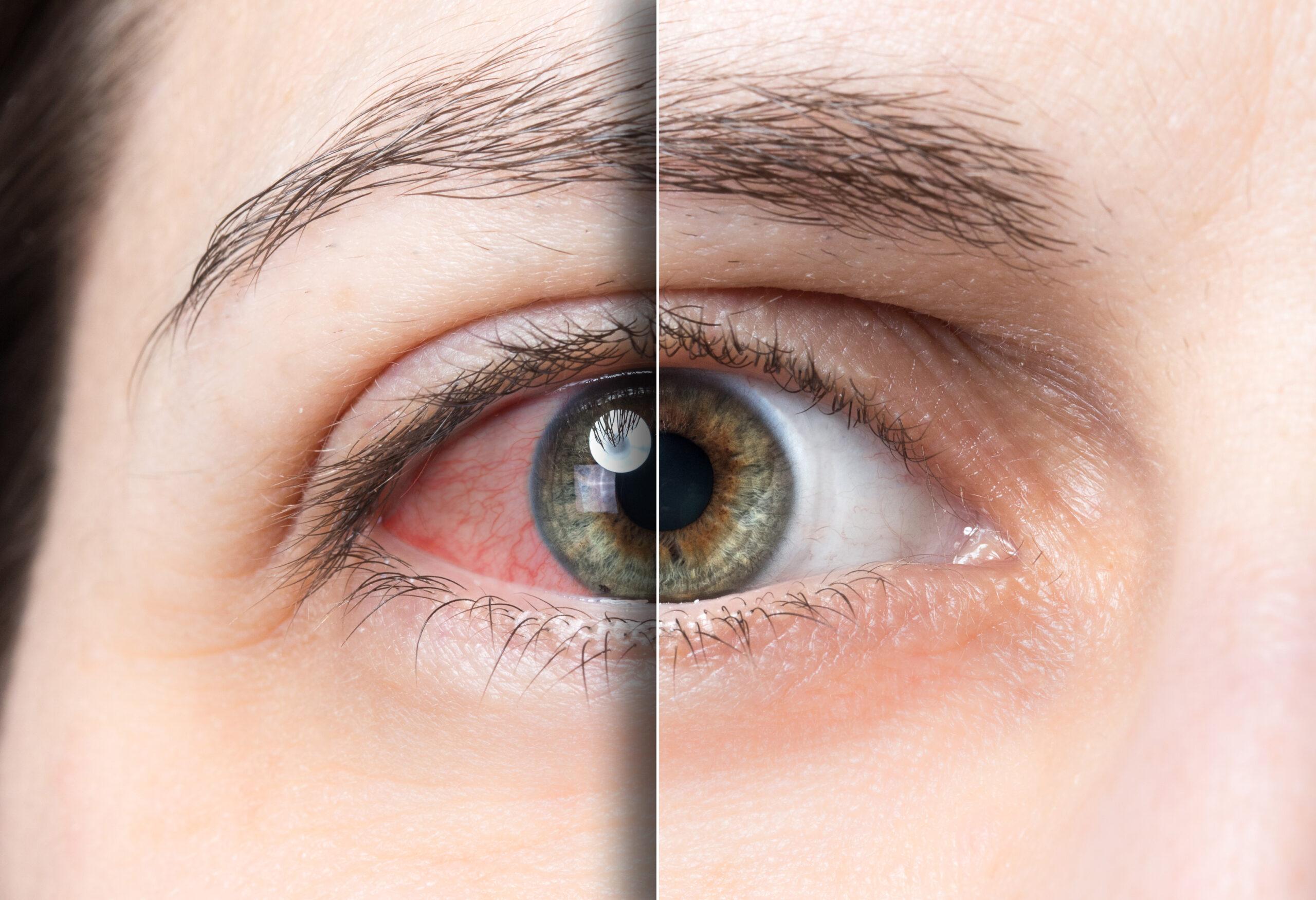 Как долго заживает роговица глаза после операции?