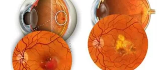 Как лечить сетчатку глаза?