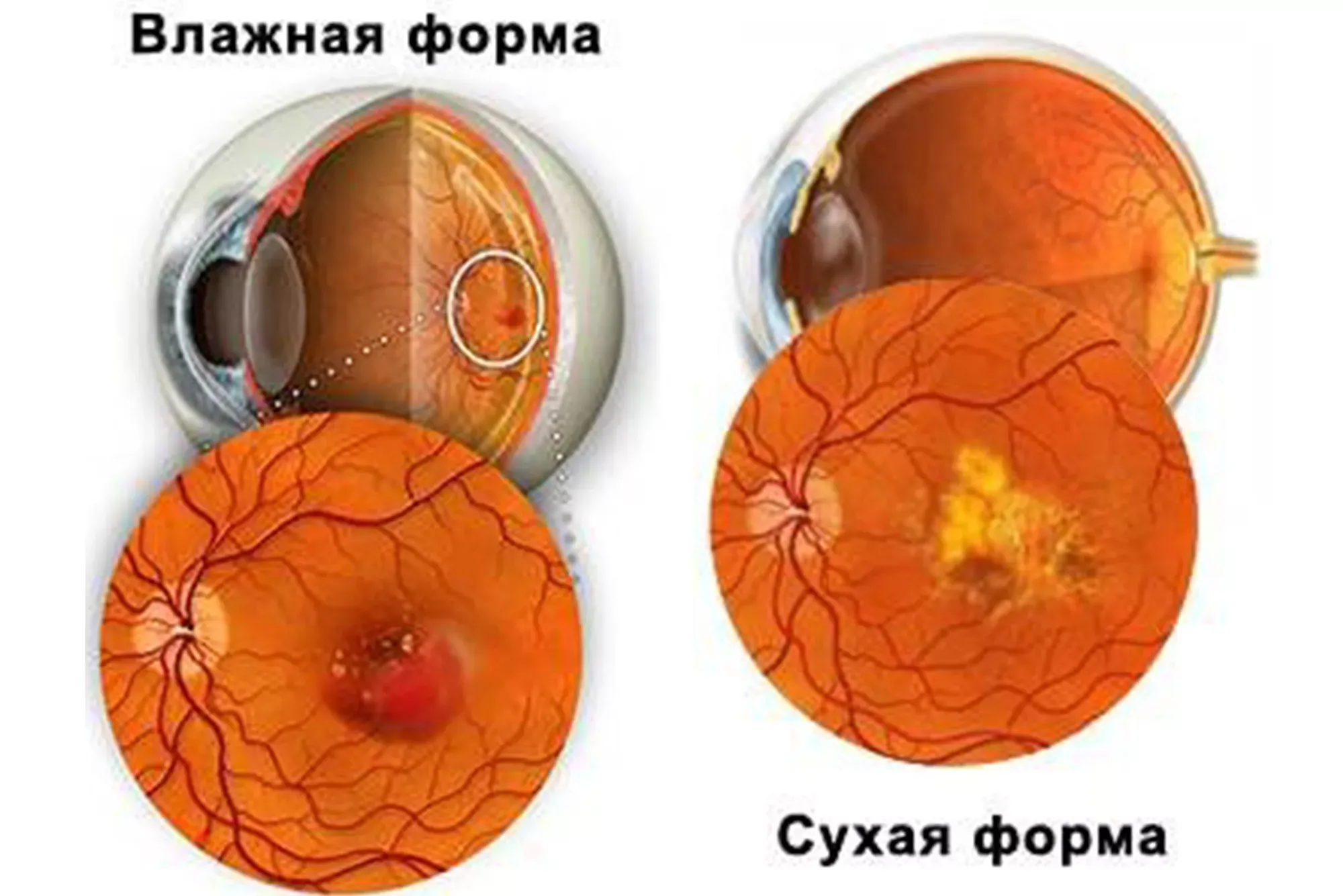 Как лечить сетчатку глаза?