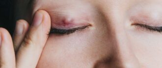 Как снять воспаление глаз в домашних условиях?