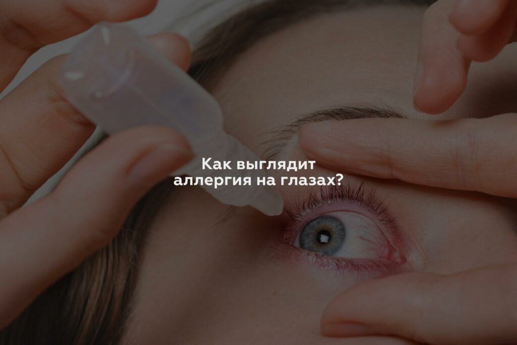 Как выглядит аллергия на глазах?