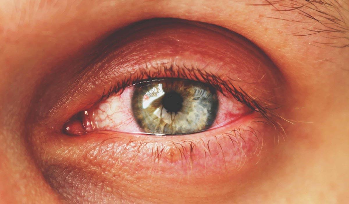 Как выглядит блефарит глаз?