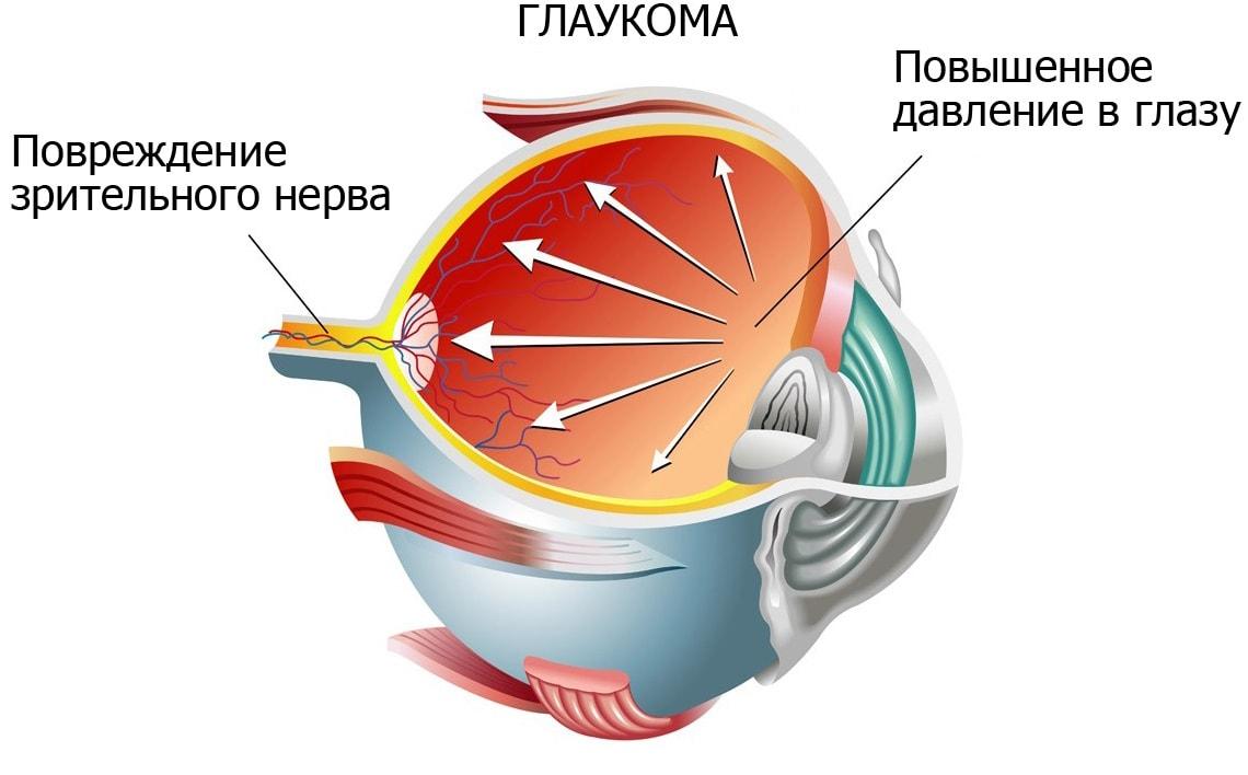 Какие первые признаки катаракты глаза?
