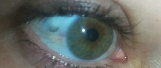 Почему на белках глаз желтые пятна?