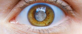 Сколько лет развивается катаракта?