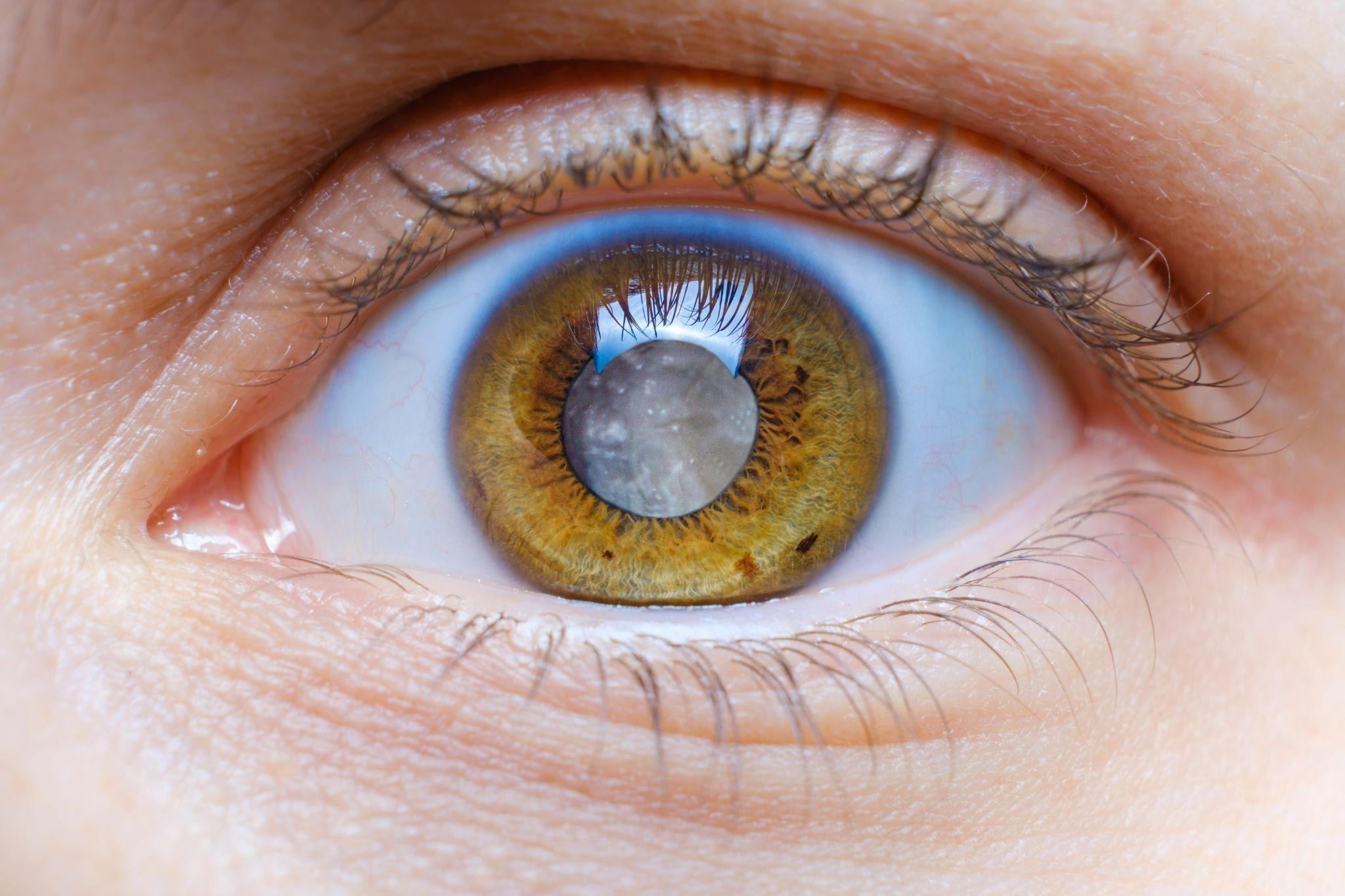 Сколько лет развивается катаракта?