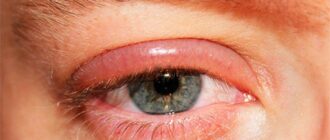 Что такое птоз глаза?