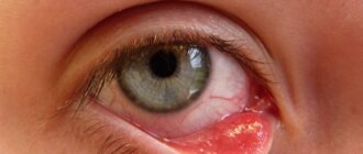 Как халязион влияет на зрение?