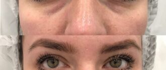 Как подтянуть кожу вокруг глаз без операции?
