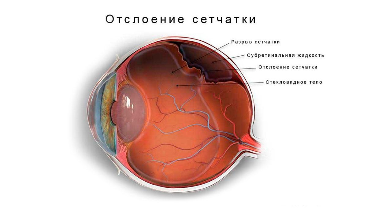 Какие признаки отслоения сетчатки глаза?